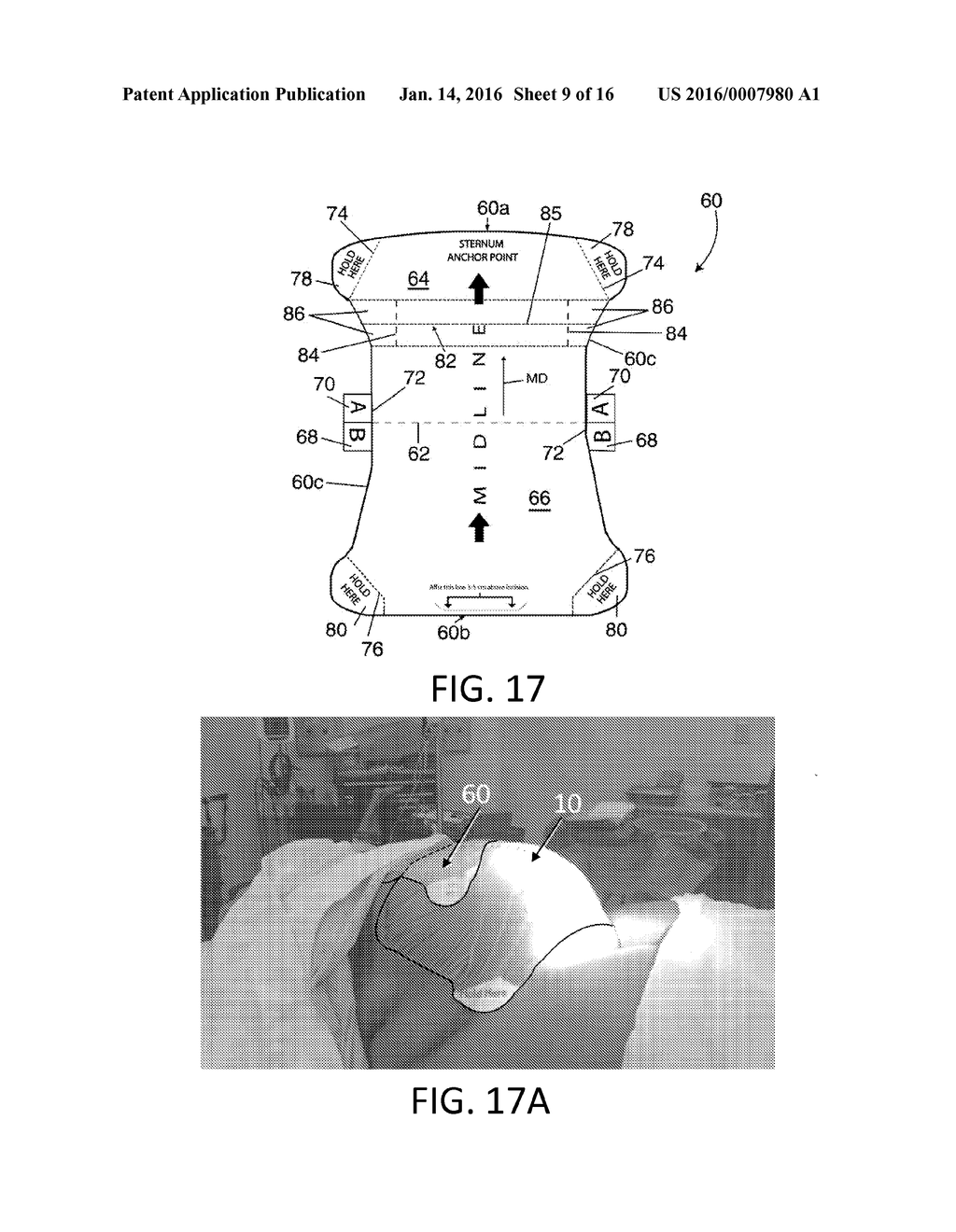 RETRACTOR/STABILIZER FOR EXCESSIVE AND/OR REDUNDANT TISSUE AND METHOD OF     USE - diagram, schematic, and image 10