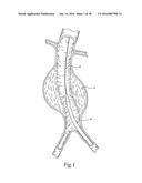 Method for Attaching a Prosthesis to Soft Tissue diagram and image