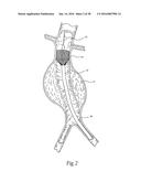 Method for Attaching a Prosthesis to Soft Tissue diagram and image