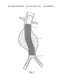 Method for Attaching a Prosthesis to Soft Tissue diagram and image