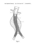 Method for Attaching a Prosthesis to Soft Tissue diagram and image