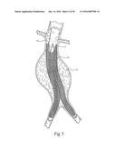 Method for Attaching a Prosthesis to Soft Tissue diagram and image