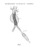 Method for Attaching a Prosthesis to Soft Tissue diagram and image