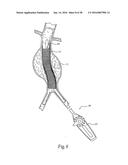 Method for Attaching a Prosthesis to Soft Tissue diagram and image