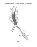 Method for Attaching a Prosthesis to Soft Tissue diagram and image