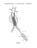 Method for Attaching a Prosthesis to Soft Tissue diagram and image