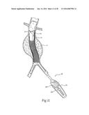 Method for Attaching a Prosthesis to Soft Tissue diagram and image