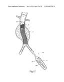 Method for Attaching a Prosthesis to Soft Tissue diagram and image