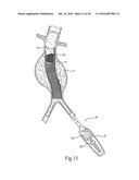 Method for Attaching a Prosthesis to Soft Tissue diagram and image