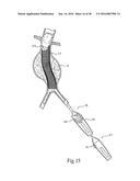 Method for Attaching a Prosthesis to Soft Tissue diagram and image