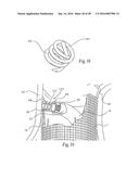 Method for Attaching a Prosthesis to Soft Tissue diagram and image