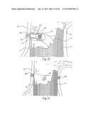 Method for Attaching a Prosthesis to Soft Tissue diagram and image