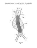 Method for Attaching a Prosthesis to Soft Tissue diagram and image