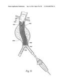 Method for Attaching a Prosthesis to Soft Tissue diagram and image