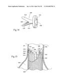 Method for Attaching a Prosthesis to Soft Tissue diagram and image