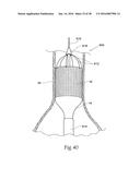 Method for Attaching a Prosthesis to Soft Tissue diagram and image