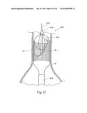 Method for Attaching a Prosthesis to Soft Tissue diagram and image