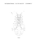 PERCUTANEOUS SYSTEM AND METHODS FOR ENHANCED EPIDURAL ACCESS FOR SPINE     SURGERY diagram and image