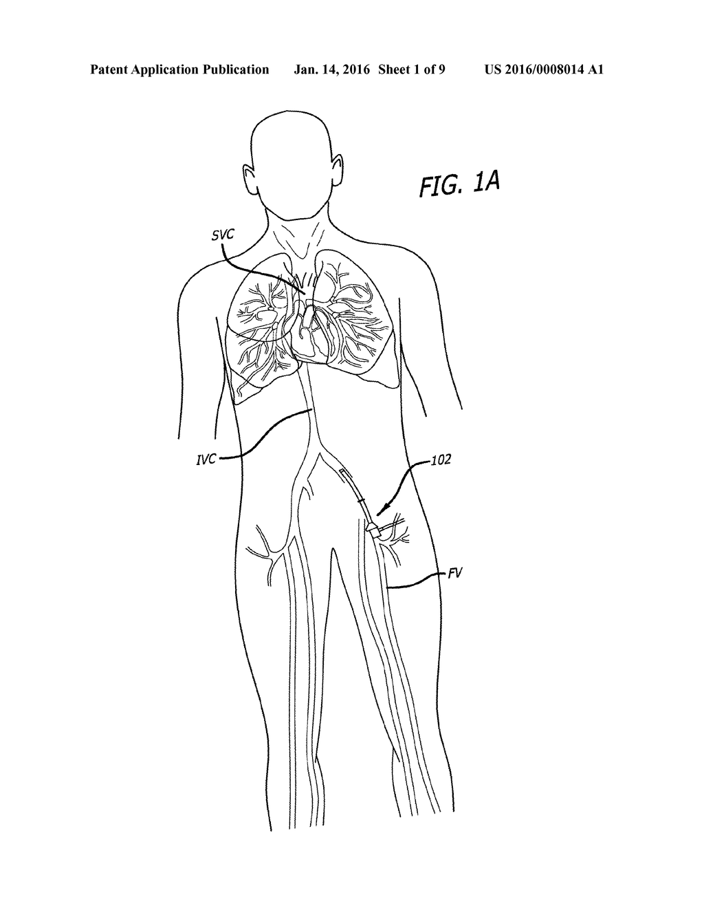 METHODS AND APPARATUS FOR TREATING EMBOLISM - diagram, schematic, and image 02