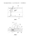 Blood Vessel Treatment with Pressure Shock Waves diagram and image