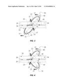 Blood Vessel Treatment with Pressure Shock Waves diagram and image