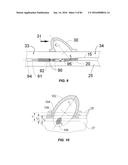 Blood Vessel Treatment with Pressure Shock Waves diagram and image