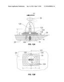 Blood Vessel Treatment with Pressure Shock Waves diagram and image