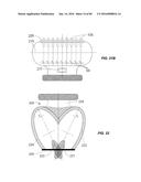 Blood Vessel Treatment with Pressure Shock Waves diagram and image