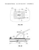 Blood Vessel Treatment with Pressure Shock Waves diagram and image