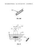 Blood Vessel Treatment with Pressure Shock Waves diagram and image