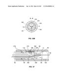 Blood Vessel Treatment with Pressure Shock Waves diagram and image