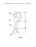 Blood Vessel Treatment with Pressure Shock Waves diagram and image