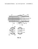 Blood Vessel Treatment with Pressure Shock Waves diagram and image