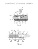 Blood Vessel Treatment with Pressure Shock Waves diagram and image