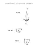 Blood Vessel Treatment with Pressure Shock Waves diagram and image