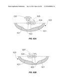 Blood Vessel Treatment with Pressure Shock Waves diagram and image