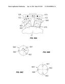 Blood Vessel Treatment with Pressure Shock Waves diagram and image