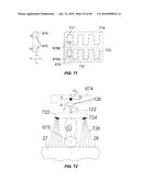 Blood Vessel Treatment with Pressure Shock Waves diagram and image