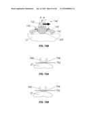 Blood Vessel Treatment with Pressure Shock Waves diagram and image