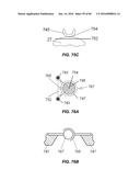 Blood Vessel Treatment with Pressure Shock Waves diagram and image