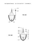 Blood Vessel Treatment with Pressure Shock Waves diagram and image