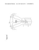 UTERINE LAVAGE FOR EMBRYO RETRIEVAL diagram and image