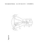 UTERINE LAVAGE FOR EMBRYO RETRIEVAL diagram and image