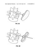 SYSTEM AND METHOD FOR STABILIZING A POSTERIOR FUSION OVER MOTION SEGMENTS diagram and image