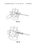 SYSTEM AND METHOD FOR STABILIZING A POSTERIOR FUSION OVER MOTION SEGMENTS diagram and image