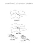 FACET JOINT IMPLANTS AND DELIVERY TOOLS diagram and image