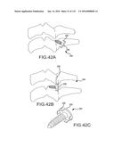 FACET JOINT IMPLANTS AND DELIVERY TOOLS diagram and image