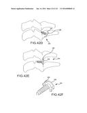 FACET JOINT IMPLANTS AND DELIVERY TOOLS diagram and image