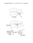 FACET JOINT IMPLANTS AND DELIVERY TOOLS diagram and image