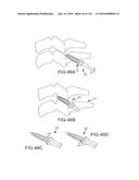 FACET JOINT IMPLANTS AND DELIVERY TOOLS diagram and image